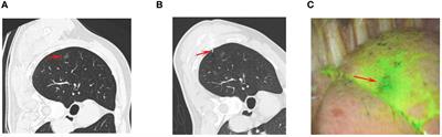 Comparison of indocyanine green and blue-stained glue for preoperative localization for pulmonary nodules